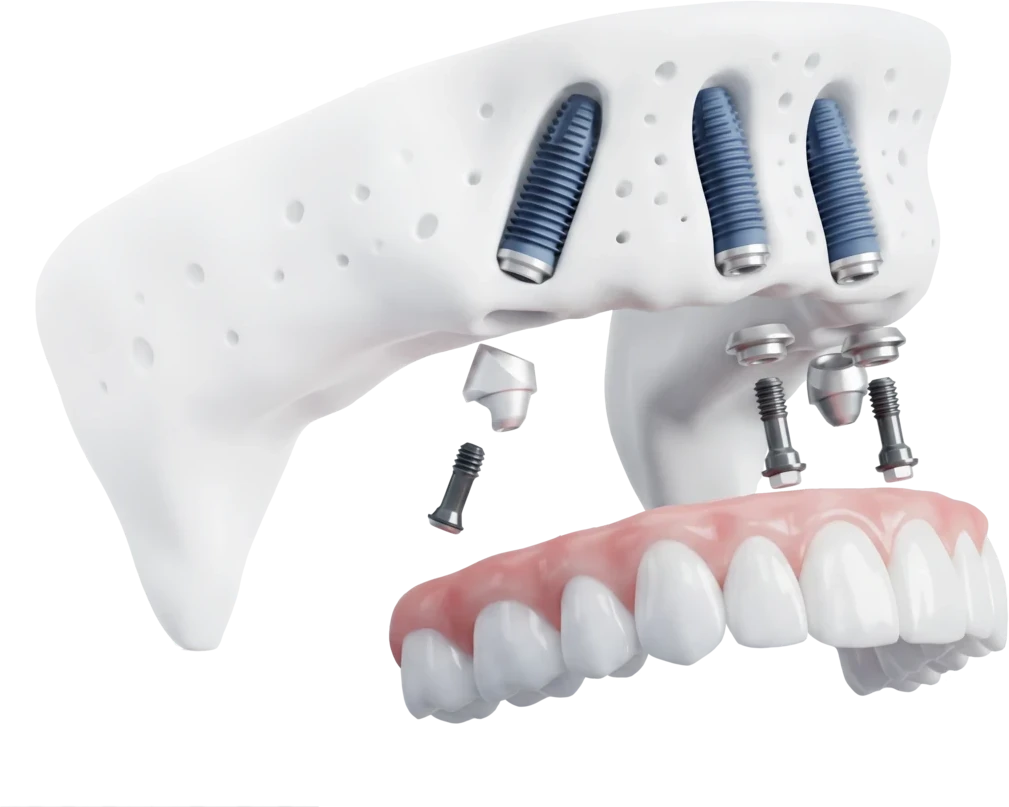 3D-Rendering Implantat-Versorgung mit Brücke
